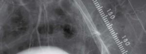 stent1